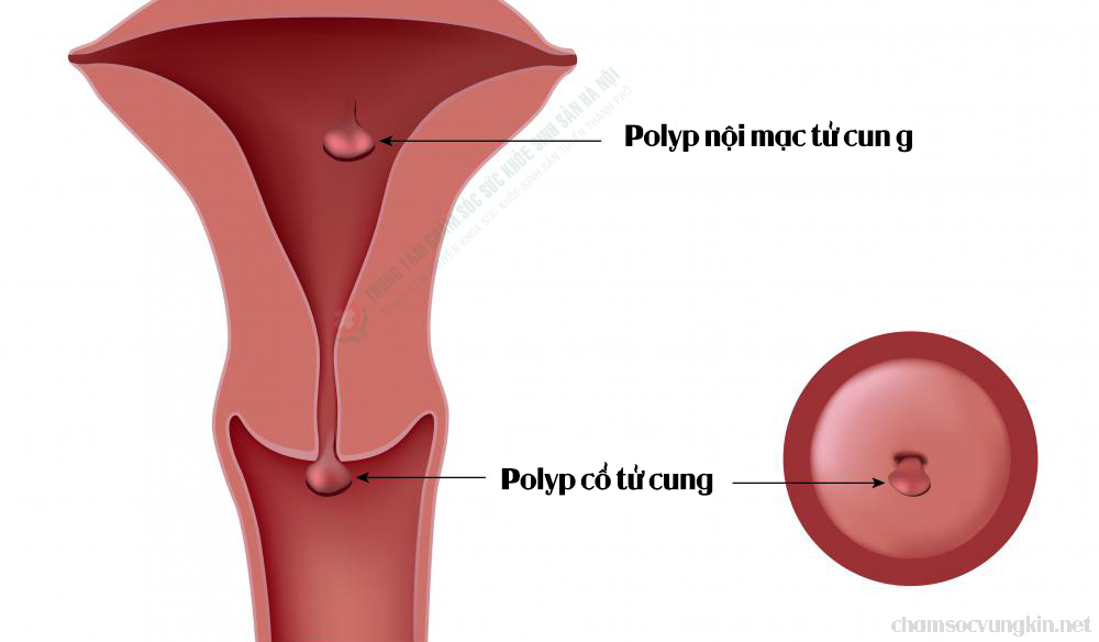 polyp-co-tu-cung-vaginal-polyps
